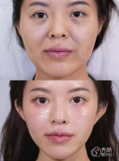 成都自体脂肪丰面