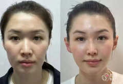 青岛自体脂肪丰面