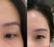 长沙自体脂肪丰面