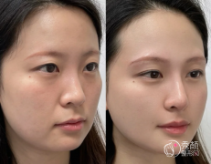 武汉自体脂肪丰面