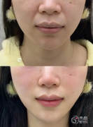 重庆自体脂肪丰面