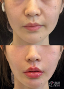 深圳自体脂肪丰面