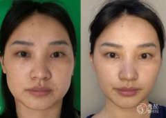 重庆埋线提升医生