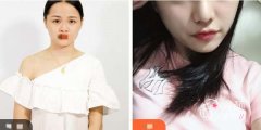 张金明鼻修复怎么