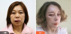 西安拉皮手术哪位