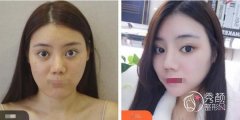 华西吸脂哪个医生